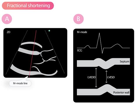 fractional shortening vs ejection fraction.